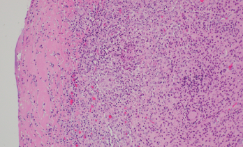 Synovium with granulomatous inflammation consisting of aggregates of histiocytes and multinucleated giant cells, with surrounding lymphocytes and plasma cells. Sections contain no identifiable organisms or crystal deposition. (GMS and AFB immunohistochemical stains were negative.) H&E, 100x. Source: Picture and description by Mary Hansen Smith MD, University of Arizona, Department of Pathology.