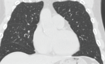 High-resolution computed tomography of the chest demonstrated sub-centimeter, scattered nodularity consistent with disseminated Mycobacterium avium complex.