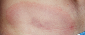 Erythema migrans rash in Lyme disease.