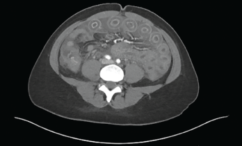 Figure 1: Computed Tomography of the Abdomen