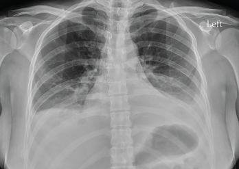 Figure 2: Radiograph of the Chest