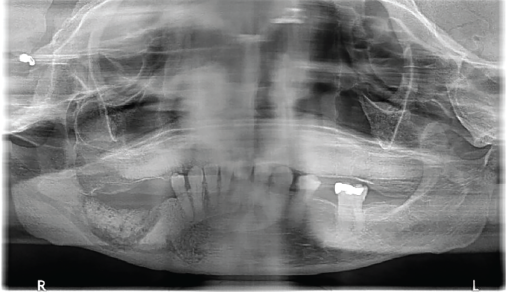 A panoramic radiograph shows sequestrum formation in the right mandible.