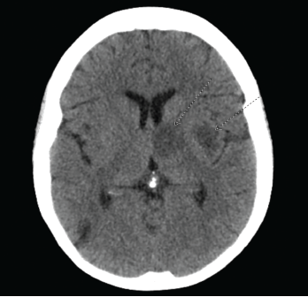CT of the head reveals multiple bihemispheric regions of hypodensity, as well as evidence of remote multifocal cortical and subcortical infarcts