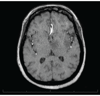 MRI of the brain shows innumerable enhancing lesions scattered throughout the bilateral cerebral and cerebellar hemispheres. 
