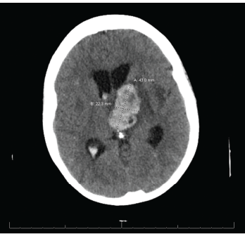CT reveals a large left thalamic intraparenchymal hemorrhage with intraventricular extension causing obstructive hydrocephalus.