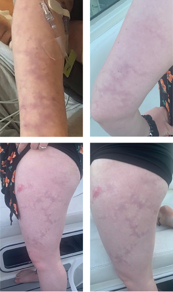 Livedo racemosa, a cutaneous finding characterized by a persistent, erythematous or violaceous discoloration of the skin, in a broken, branched, discontinuous and irregular pattern, is apparent on the patient’s arms and legs.