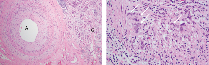 FigureS 1A (left) & 1B: Pathologic Findings of Submandibular Gland Resection