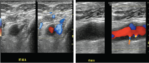 Figures 2a & 2B (from left): Vascular Ultrasound Images