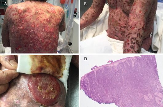 Figures 1 A–B: Numerous ulcerative lesions with sharply angulated edges are shown. Figure 1C: A new tumorous lesion is shown on the patient’s leg. Figure 1D: A biopsy of an ulcerated skin segment revealed an atypical mononuclear infiltrate.