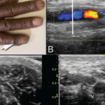 Clockwise from top: Image A shows the periungual ulceration (arrow) of the fifth digit, as well as the prior amputation of the second digit. Image B shows a longitudinal ultrasound of the palmar aspect of the ulnar right wrist. In the center of the image, the ulnar artery is in view and color Doppler flow is visualized within the vessel until there is a reversal of flow demonstrated by color change, followed by severe attenuation of flow distally. Distal to the cessation of flow, the vessel appears hypoechoic due to proliferation of the intima to the point of occluding the lumen. Image C shows a transverse view at the level of white line in Image B, with endothelial proliferation seen around a central lumen of the artery (a), next to the vein (v) and ulnar nerve (n). Image D, shows a transverse view at the level of the black line in Image B, where the arterial lumen (a) is occluded.