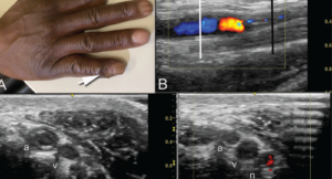 Clockwise from top: Image A shows the periungual ulceration (arrow) of the fifth digit, as well as the prior amputation of the second digit. Image B shows a longitudinal ultrasound of the palmar aspect of the ulnar right wrist. In the center of the image, the ulnar artery is in view and color Doppler flow is visualized within the vessel until there is a reversal of flow demonstrated by color change, followed by severe attenuation of flow distally. Distal to the cessation of flow, the vessel appears hypoechoic due to proliferation of the intima to the point of occluding the lumen. Image C shows a transverse view at the level of white line in Image B, with endothelial proliferation seen around a central lumen of the artery (a), next to the vein (v) and ulnar nerve (n). Image D, shows a transverse view at the level of the black line in Image B, where the arterial lumen (a) is occluded.