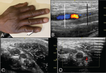 Clockwise from top: Image A shows the periungual ulceration (arrow) of the fifth digit, as well as the prior amputation of the second digit. Image B shows a longitudinal ultrasound of the palmar aspect of the ulnar right wrist. In the center of the image, the ulnar artery is in view and color Doppler flow is visualized within the vessel until there is a reversal of flow demonstrated by color change, followed by severe attenuation of flow distally. Distal to the cessation of flow, the vessel appears hypoechoic due to proliferation of the intima to the point of occluding the lumen. Image C shows a transverse view at the level of white line in Image B, with endothelial proliferation seen around a central lumen of the artery (a), next to the vein (v) and ulnar nerve (n). Image D, shows a transverse view at the level of the black line in Image B, where the arterial lumen (a) is occluded.