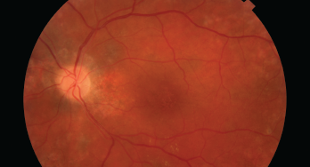 This image shows damage to the retina, which can be caused by HCQ.