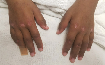 Gottron papules were evident on the patient's hands at presentation.