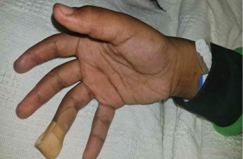 The patient had a purplish discoloration and digital ulcers on the distal tips of his thumb, index and middle fingers.