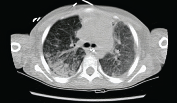 The initial chest CT showed diffuse bilateral airspace opacities.