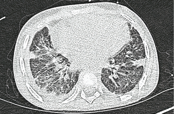 A high-resolution CT scan after one month shows interstitial thickening opacities and thickening of the interlobular septa.