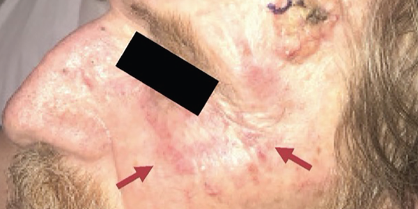The physical examination revealed multiple, large, erythematous pearly nodules suggestive of basal cell carcinoma, as shown on his left temple, and a diffuse poikilodermic rash (maroon arrows).
