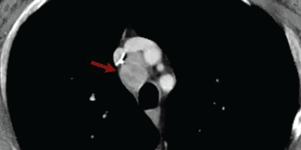 A contrasted CT scan of the chest shows numerous pathologic mediastinal and right hilar lymph nodes (maroon arrow). 