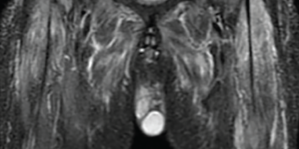 An MRI myositis protocol of the lower extremities with extensive, symmetric edema-like T2 signal of both thighs and the pelvis musculature.