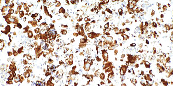 An ultrasound-guided, fine-needle aspiration biopsy of the mediastinal lymph nodes shows rare tumor cells. Immunohistochemical testing revealed the presence of cytokeratin 7 and thyroid transcription factor 1.