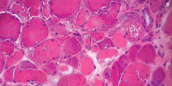 H&E staining of a muscle biopsy demonstrates myopathic changes, fiber necrosis and fiber atrophy, albeit a paucity of inflammatory cells.
