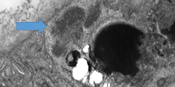 Electron microscopy of a muscle biopsy shows tubuloreticular inclusions (blue arrow).