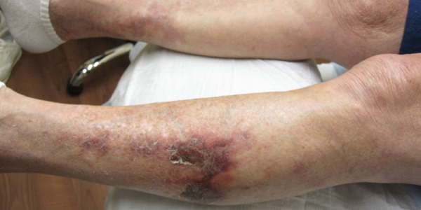 Reticulated violaceous rash of the bilateral lower extremities found on initial presentation.