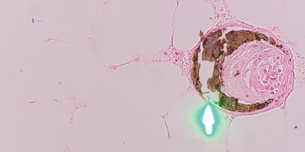 H&E and Von Kossa stain, respectively. The third set of biopsies revealed subcutaneous fibrin thrombi involving the microvasculature, intimal wall thickening and stippled, partially occlusive calcification consistent with calciphylaxis.