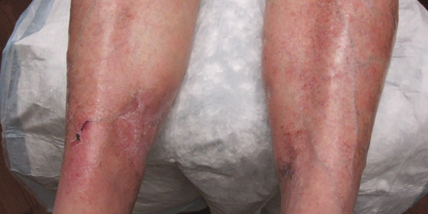 Healing lesions on both legs. 