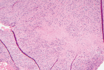 Biopsies of the small bowel mesenteric and serosal nodules demonstrated necrotizing granulomatous inflammation.