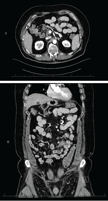 Figures 2 & 3 A CT enterography showed infiltrating soft tissue masses within the mesentery in a predominantly perienteric distribution.