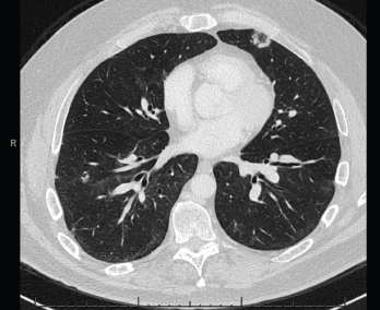 A CT scan of the chest without contrast showed multifocal, multilobar, subsegmental-sized opacities, which were nodules in some locations and more ill-defined lesions in others.