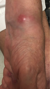 A lesion present on the patient’s left wrist at a clinic appointment in September 2018.