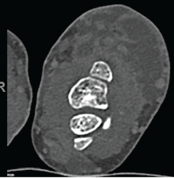 Multiloculated fluid collections in the dorsal subcutaneous tissue of the distal ulna seen on CT scan.