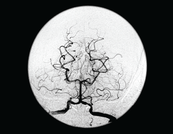 This frontal view from a vertebral angiogram shows the typical appearance of intracranial vasculitis.