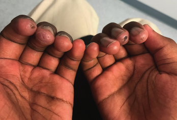 Figure 1: A 12-year-old Black male presented with digital ulcers and swelling.