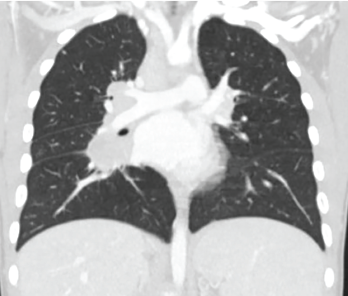 Figure 2: High-resolution computed tomography showed evidence of interstitial lung disease.