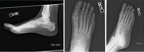 Figure 1: Radiographs of Right Foot, 2012 
