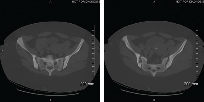 Figure 2: CTs of the Abdomen and Pelvis, Focus on the Sacroiliac Joints, 2020