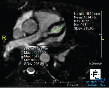 Giant LAD fusiform aneurysm measuring 9.8 mm in diameter (z-score = 19) and extending approximately 17 mm.