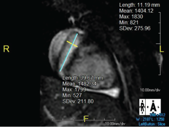 The right coronary artery sustained a giant fusiform aneurysm 11 mm in diameter (z-score = 20) and 40 mm in length.