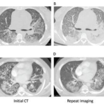 2 Cases of SLE-Associated Diffuse Alveolar Hemorrage