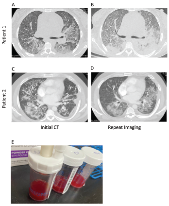 Computed tomography (CT) imaging of patient 1’s thorax at initial presentation (A) and two weeks after initial diagnosis prior to initiation of plasmapheresis (B) demonstrate bilateral, basilar consolidations. CT imaging of patient 2’s thorax at initial presentation (C) and at readmission (D) demonstrate consolidations with peripheral sparing. Panel E shows sequential bronchoalveolar lavage aliquots from patient 2, from right to left, that were progressively more hemorrhagic with consecutive fluid washes.