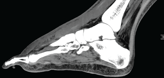 Figure 3: CT imaging shows a large amount of inflammation and swelling centered on the dorsal midfoot and tenosynovitis without evidence of a discrete drainable fluid collection, soft tissue gas, radiopaque foreign body, osseous erosion or fracture.