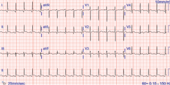 The ECG shows widespread ST elevation, along with PR segment deviation more prominent in leads I, II, AVF and AVR, suggestive of acute pericarditis.