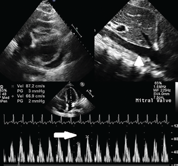A circumferential pericardial effusion with collapsing RV chamber in early diastole, along with dilated IVC (arrowhead); inflow variation approximately 25% across the MV is suggestive of tamponade physiology (arrow). Key: RV = right ventricle; MV = mitral valve