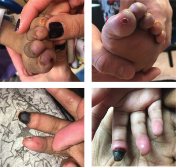 A 5-year-old girl presented with erythema and ulcerations of the finger- and toetips, which had progressed to ischemia of the right, third fingertip. 