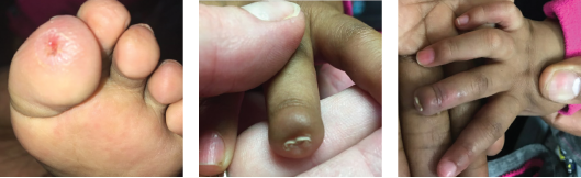 The patient’s erythema and ulcerations improved, and her ischemic digit auto-amputated. v