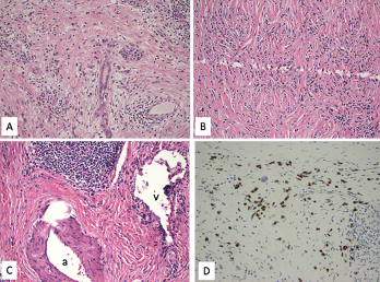 A. Lymphoplasmacytic infiltrate with pancreatic exocrine component atrophy. There is a cluster of remaining islet cells in the pancreatic duct. H&E magnification x200; B. Dense fibrosis with storiform pattern. H&E magnification x200; C. Lymphoplasmacytic infiltrate of a vein (phlebitis) without obliteration of the lumen. H&E magnification x200; v—vein, a—artery; D. Immunostain for IgG4 highlights increased IgG4-positive plasma cells, up to 80 cells/HPF. Immunostain, magnification x200.